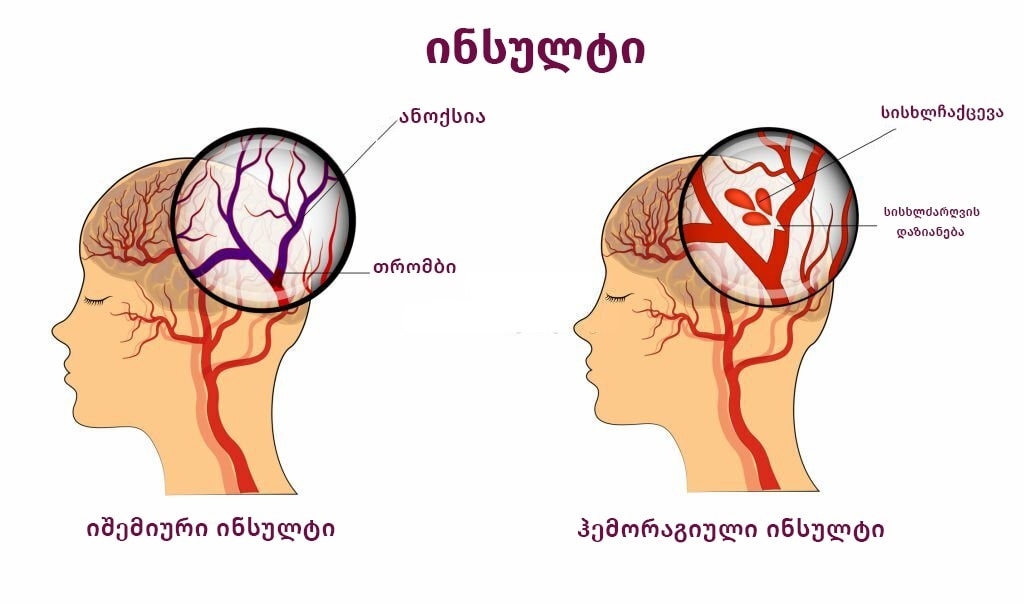 რა არის ინსულტი?