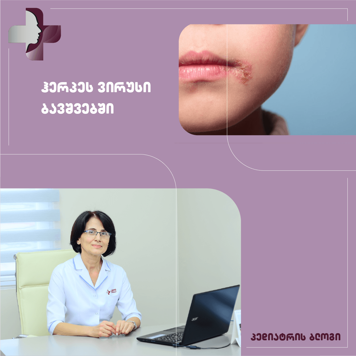 ჰერპეს ვირუსული ინფექცია