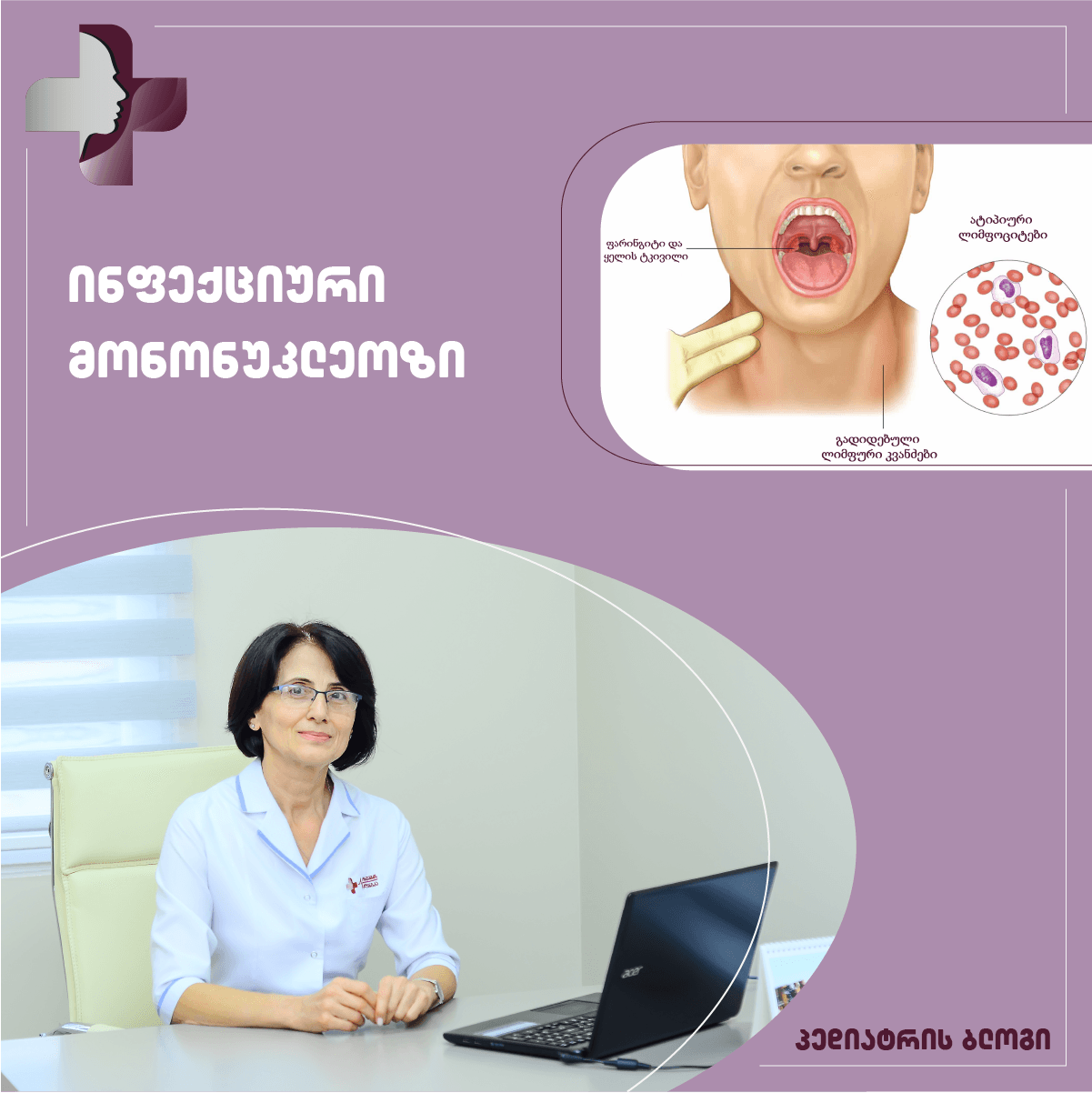 ინფექციური მონონუკლეოზი